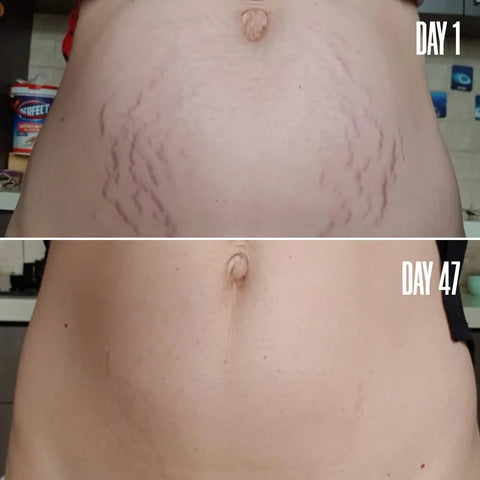 HOME STRETCH The Stretch Mark Bundle