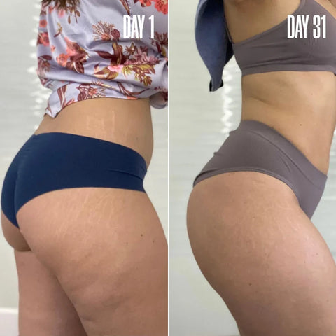 HOME STRETCH The Stretch Mark Bundle